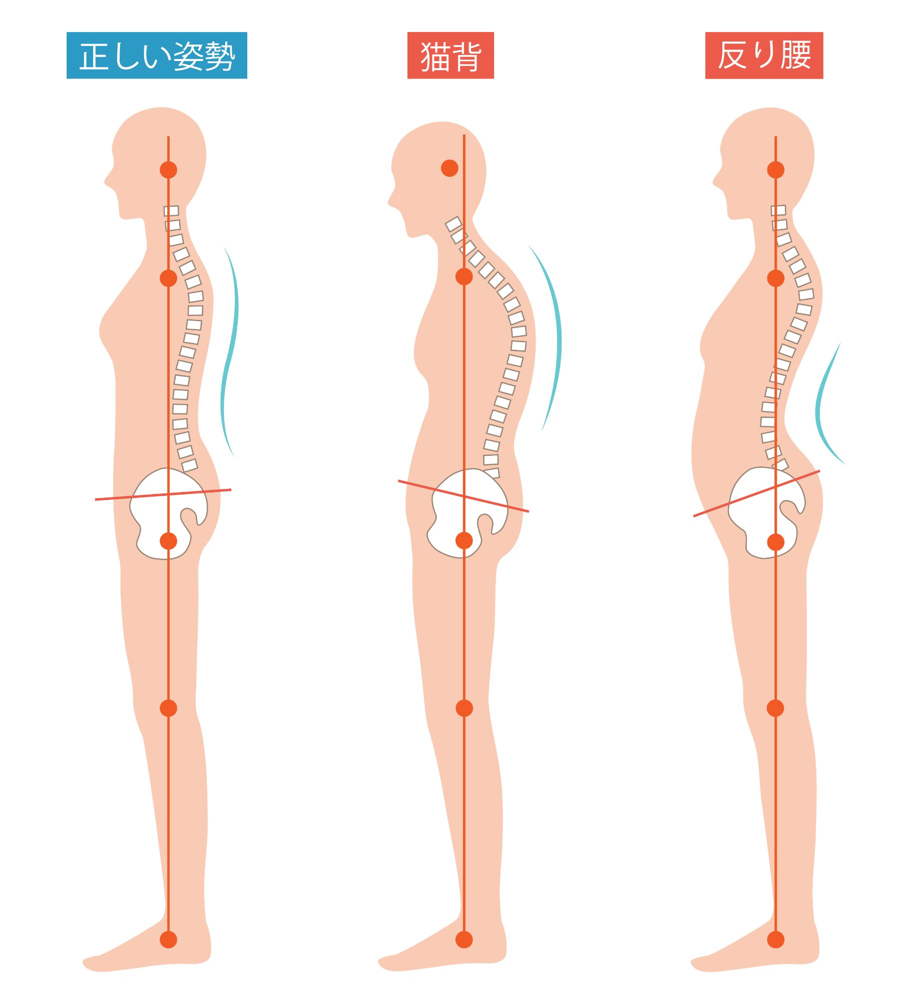 正しい姿勢・猫背・反り腰の比較図